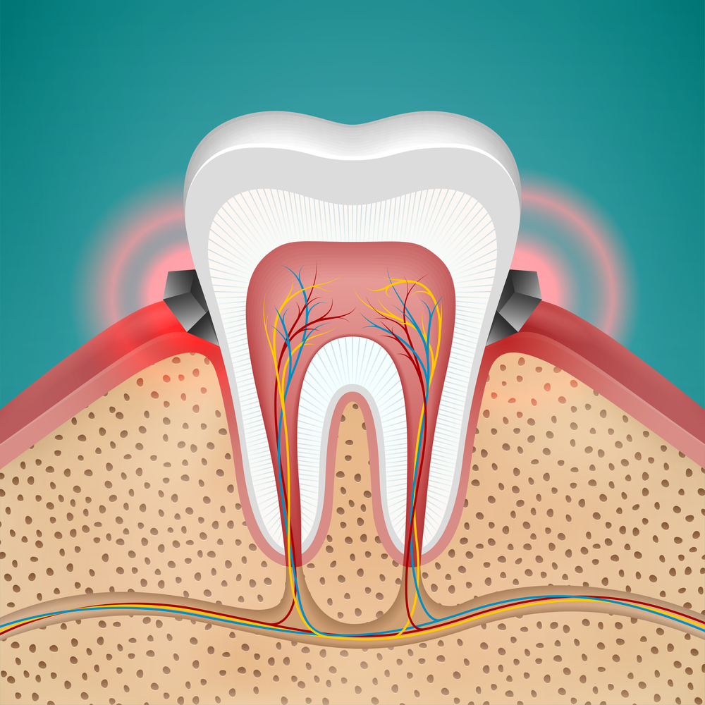 gingivitis